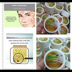Melasma Remover Cream Freckle Dark Spot Sun Damage